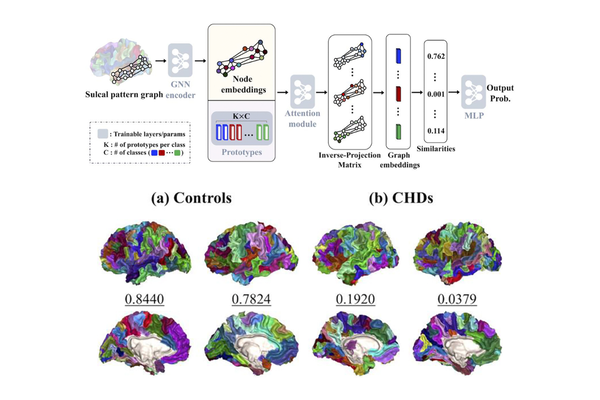 Graph-Based Prototype Inverse-Projection for Identifying Cortical Sulcal Pattern Abnormalities in Congenital Heart Disease