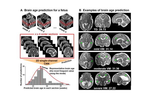 Deep Learning-Based Brain Age Prediction Using MRI to Identify Fetuses With Cerebral Ventriculomegaly.