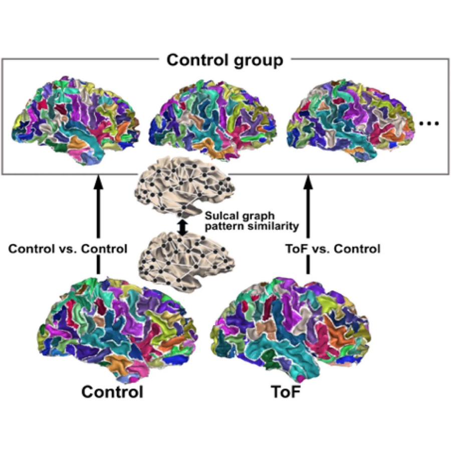 Neurodevelopment FreeSurfer